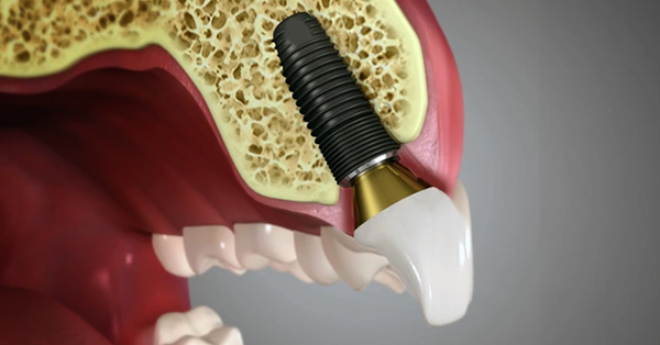 Why are dental implants necessary?