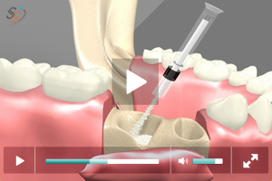 Bone Grafting - Scenario II