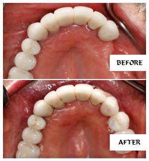 Dental Implants Case 18