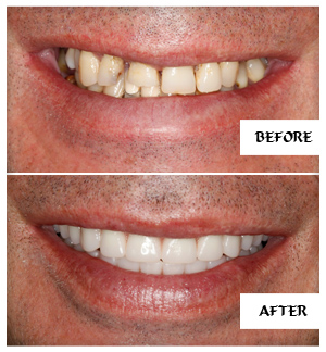 Dental Implants Case 19