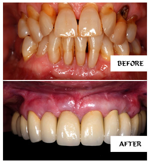 Dental Implants Case 20