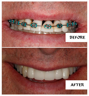 Dental Implants Case 22