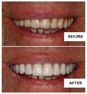 Dental Implants Case 23