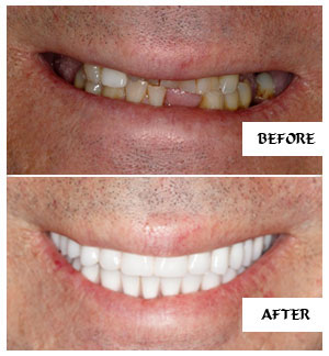 Dental Implants Case 24