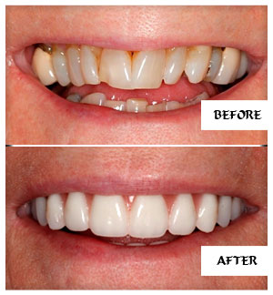 Dental Implants Case 5