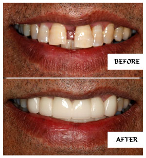 Dental Implants Case 4