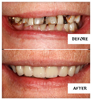 Dental Implants Case 3