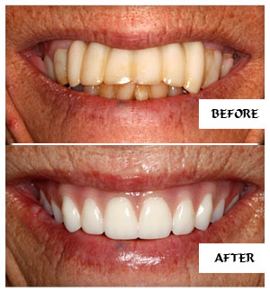 Dental Implants Case 2