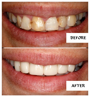 Dental Implants Case 1