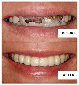 Dental Implants Case 9