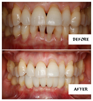 Dental Implants Case 10