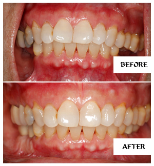 Dental Implants Case 11