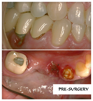 Dental Implants Case 12