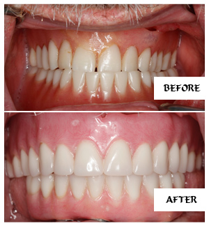 Dental Implants Case 13