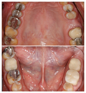 Dental Implants Case 14